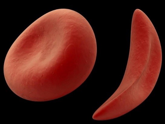 Как серповидные клетки крови прилипают к кровеносным сосудам 