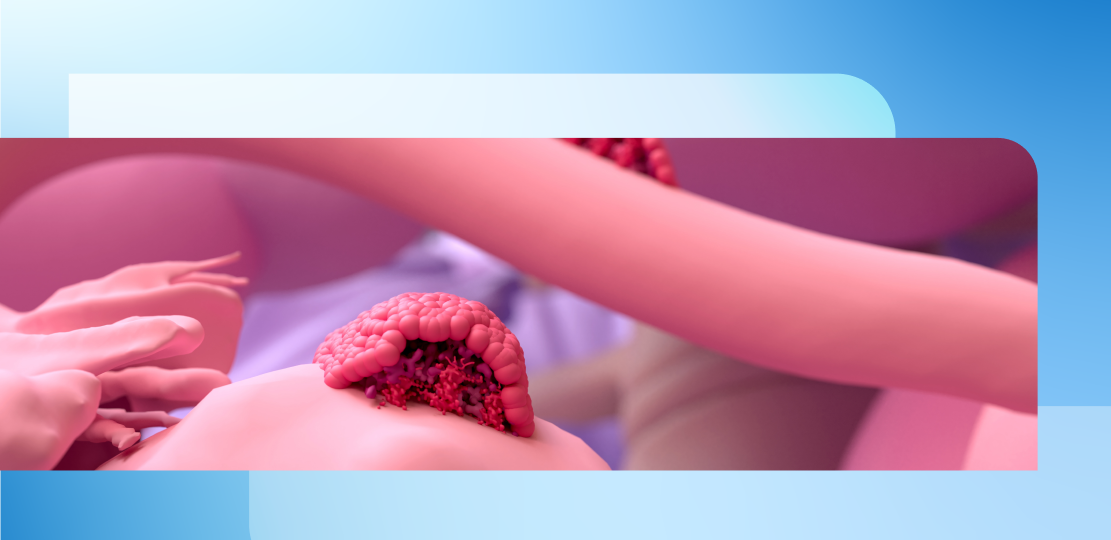 Влияние приема добавок витамина D на клинические симптомы и метаболические профили у пациенток с эндометриозом