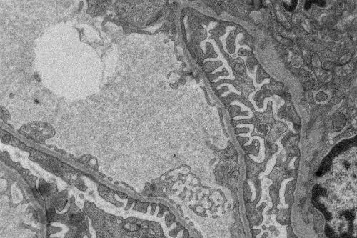 Электронно-микроскопическая картина фильтрационного барьера подоцитов