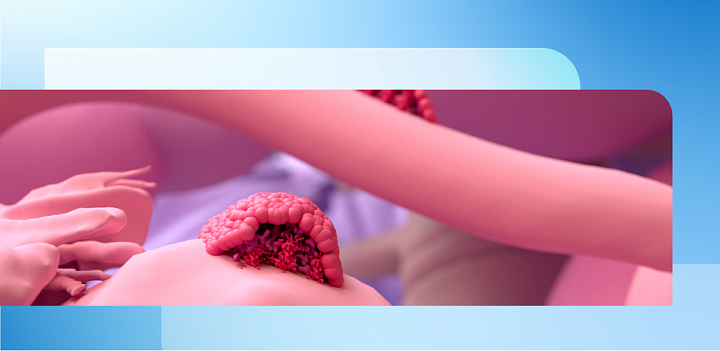 Влияние приема добавок витамина D на клинические симптомы и метаболические профили у пациенток с эндометриозом